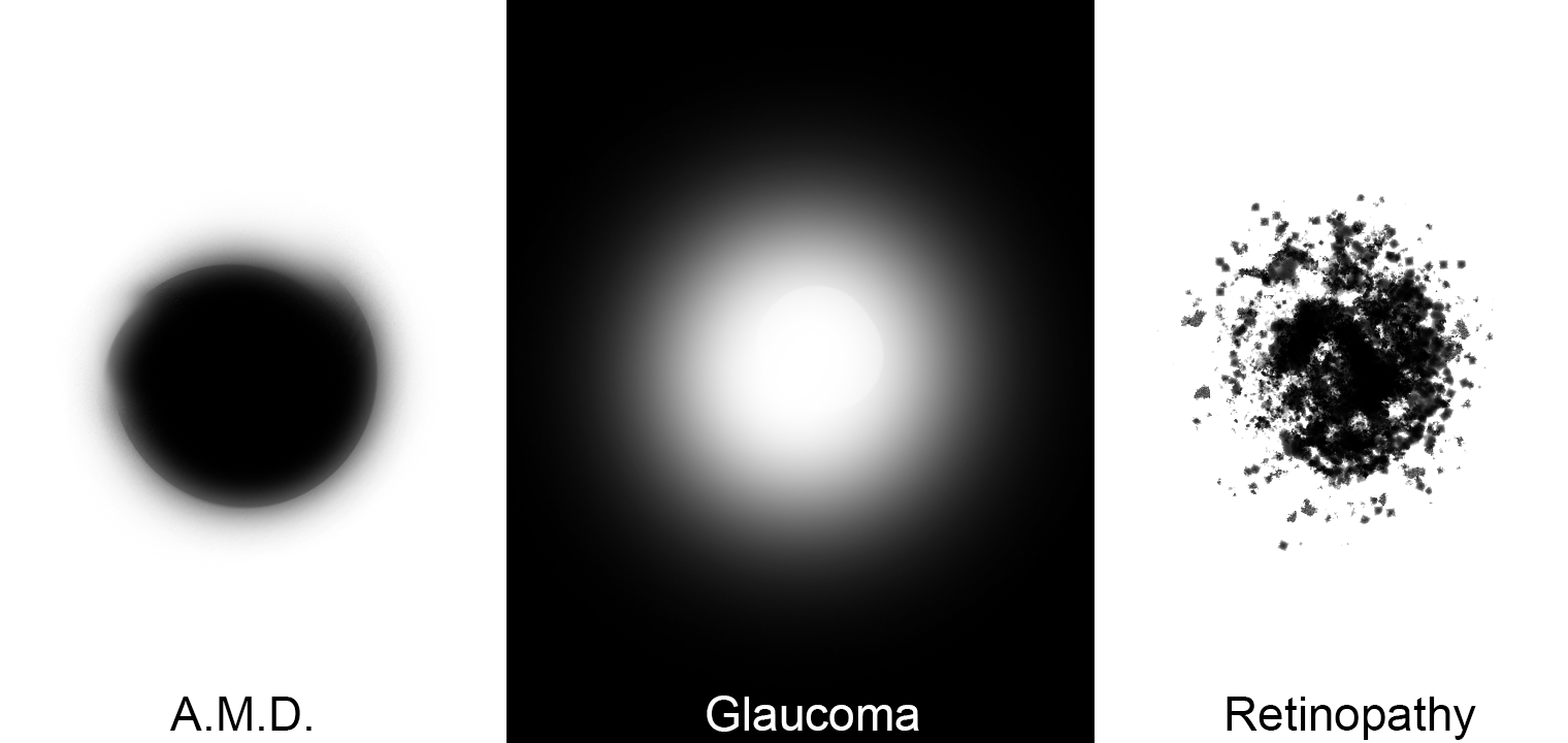 Age Related Macular Degeneration, Glaucoma, and Retinopathy image comparison.